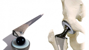 arthroplastie de l'articulation de la hanche pour l'arthrose
