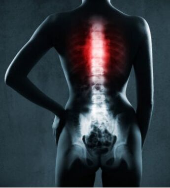 La zone affectée de la colonne vertébrale avec ostéochondrose thoracique. 