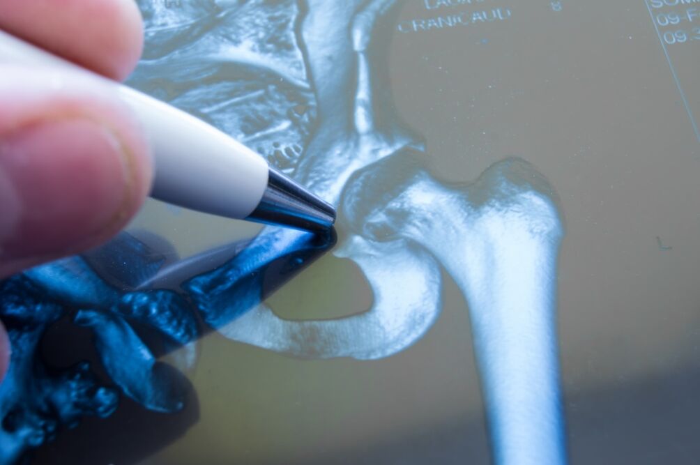 Arthrose de l'articulation de la hanche à la radiographie. 