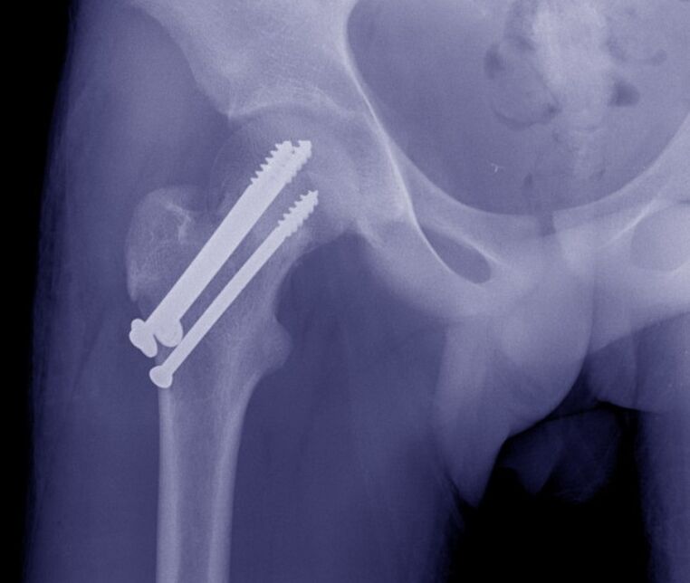 Radiographie de l'articulation de la hanche, ostéosynthèse de la fracture avec des dispositifs de fixation interne. 