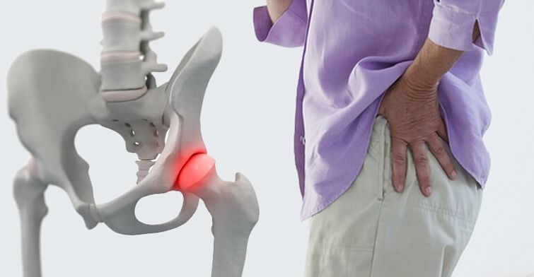 douleur dans la région de la hanche, un symptôme de l'arthrose de l'articulation de la hanche