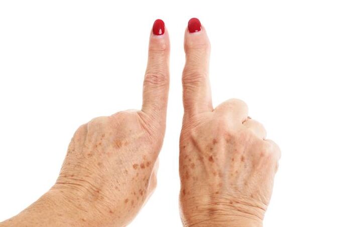 arthrose déformante des doigts