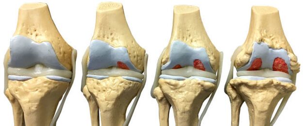 Dommages articulaires à différents stades du développement de l'arthrose de la cheville. 