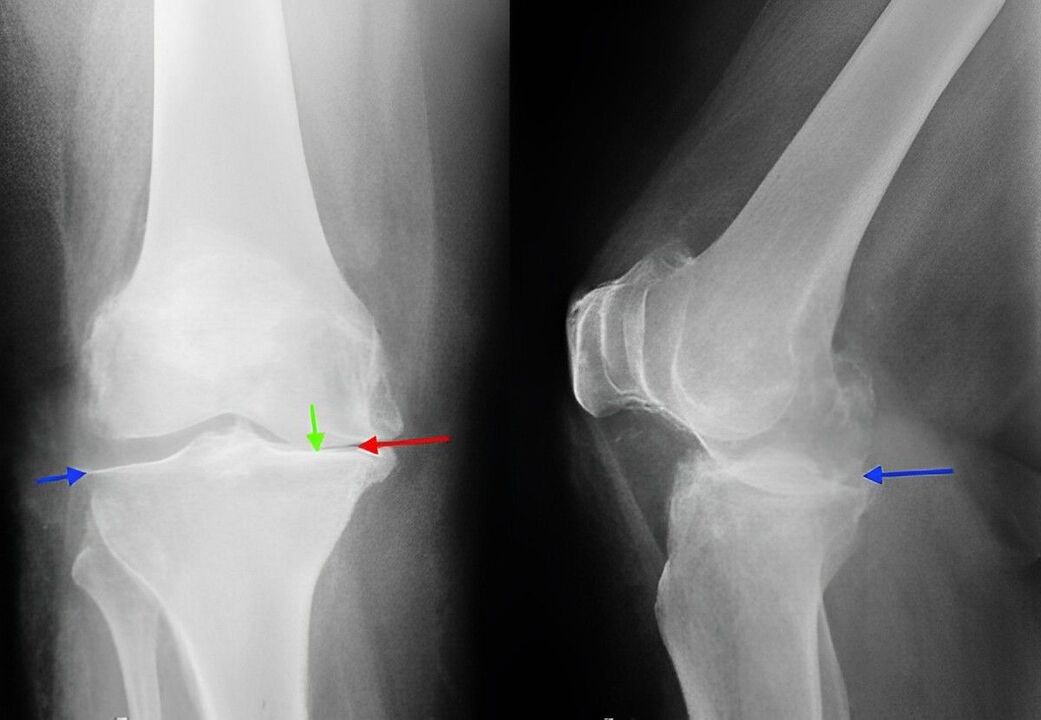Radiographie de l'arthrose de l'articulation du genou. 