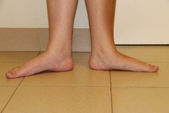 Parfois, la cause de l’arthrose du cou est les pieds plats.