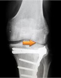 arthrose de l'articulation du genou