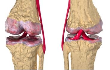 Les varices sont à l'origine du développement de la gonarthrose.